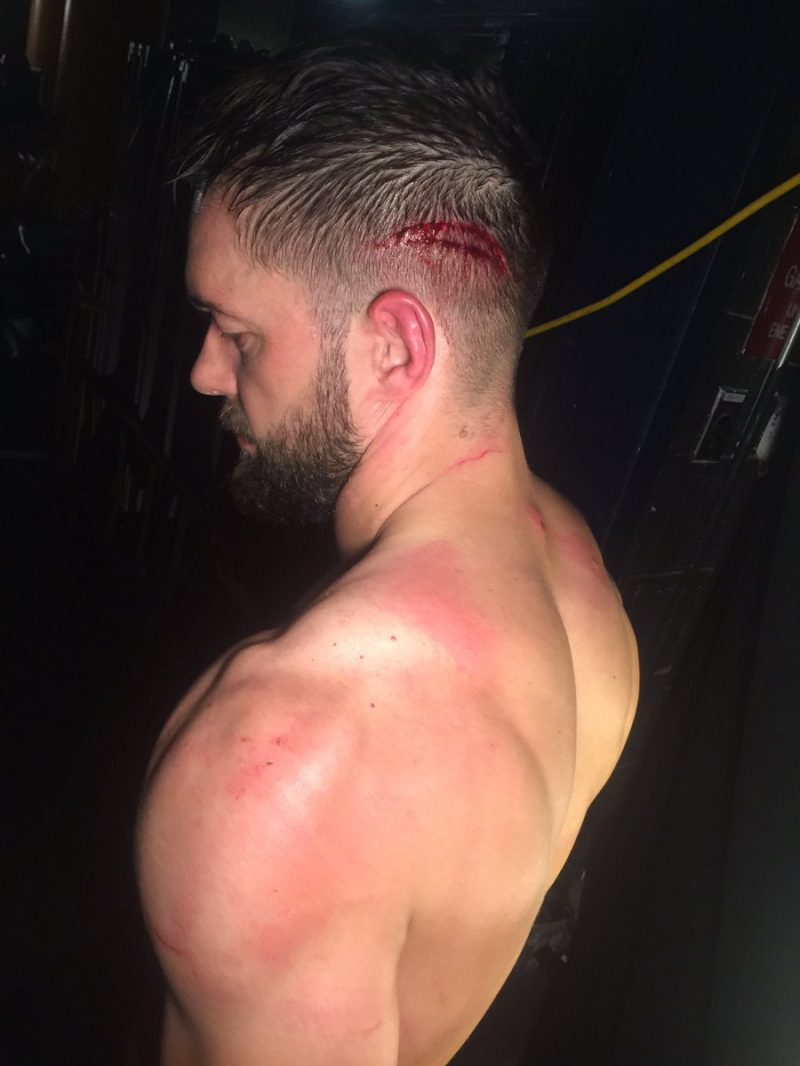 Graphic Photo of Finn Balor’s Head After the Guitar Smash on RAW