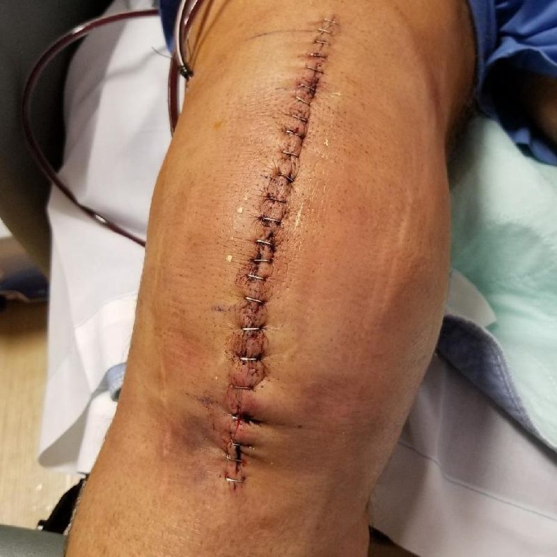 Check Out Kevin Nash’s Gigantic Scar from Recent Knee Surgery